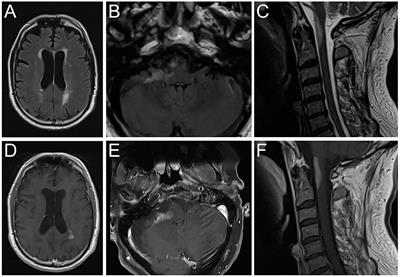 Multiple Autoimmune Syndromes Including Acute Disseminated Encephalomyelitis, Myasthenia Gravis, and Thyroiditis Following Messenger Ribonucleic Acid-Based COVID-19 Vaccination: A Case Report